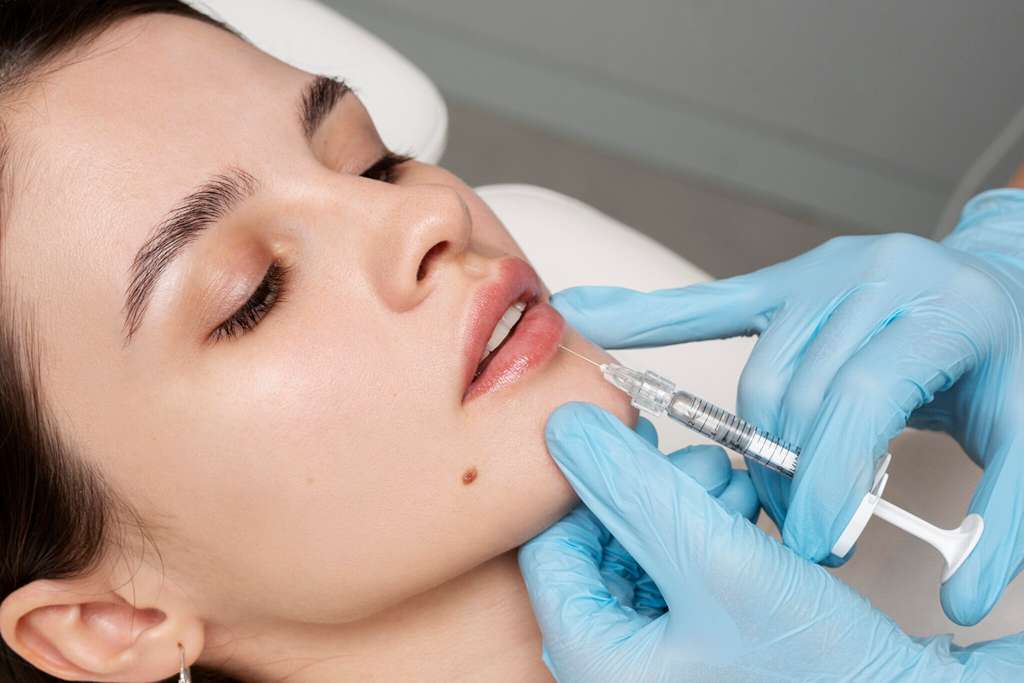 Lip Fillers