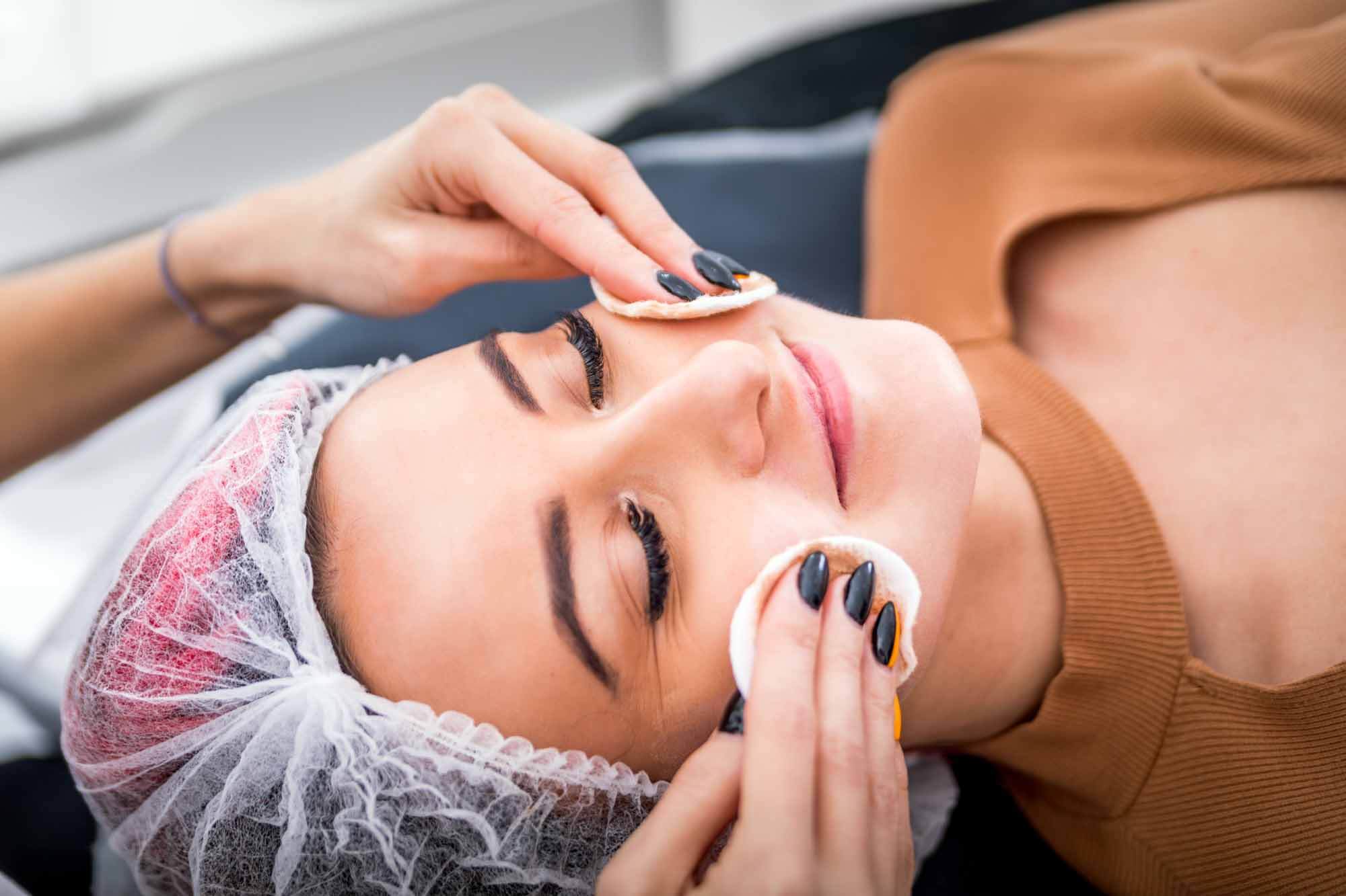 Chemical Peel